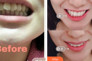 廣州愛(ài)康健口腔門診部李格整形價(jià)格表附隱形矯正案例展示