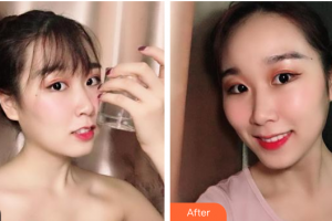 廣州愛(ài)康健口腔門診部馮曉瑛整形價(jià)格表附牙齒隱形矯正案例展示