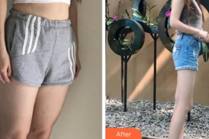 杭州新友好整形醫(yī)院韓再始整形價(jià)格表附吸脂瘦大腿案例展示