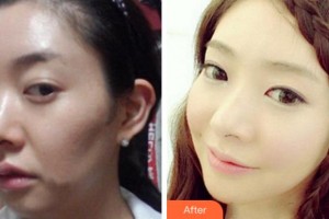 杭州新友好整形醫(yī)院袁利森整形價(jià)格表附埋線(xiàn)提升案例展示