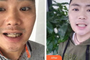 廣州市荔灣區(qū)口腔醫(yī)院黃開(kāi)清整形價(jià)格表附隱形托槽矯正案例展示