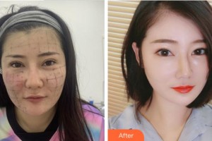 杭州東方整形外科門(mén)診部周慎健整形價(jià)格表附熱瑪吉案例展示