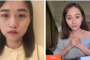 杭州東方整形外科門(mén)診部姜頌期整形價(jià)格表附抗衰老案例展示