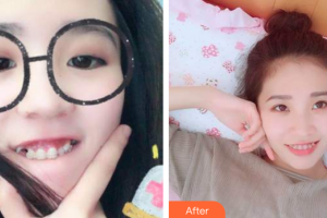 廣州健業(yè)口腔醫(yī)院李友云整形價(jià)格表附牙齒矯正案例展示