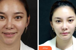 杭州瑞麗整形醫(yī)院方莉醫(yī)師整形價格表附埋線提升案例展示