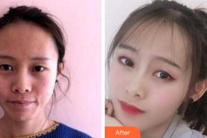 杭州昕微整形美容醫(yī)院雷小燕整形價格表附埋線提升案例展示