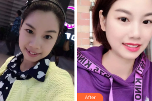 廣州市荔灣區(qū)口腔醫(yī)院趙要武整形價格表附牙齒矯正案例展示