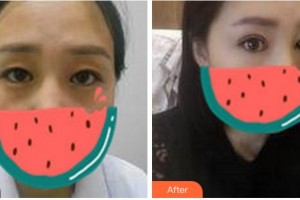 杭州東方整形外科門診部黃發(fā)明整形價格表附切開雙眼皮案例展示