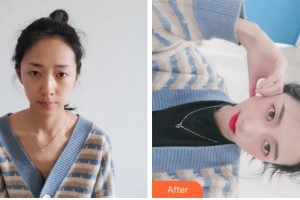 杭州新生毛發(fā)種植研究院劉海整形價格表附植發(fā)案例展示