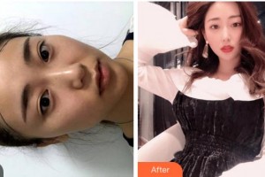 杭州新生毛發(fā)種植研究院曾令國整形價格表附種植發(fā)際線案例展示