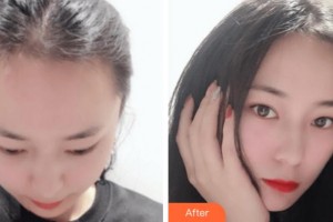 杭州新生毛發(fā)種植研究院黃云整形價格表附種植發(fā)際線案例展示