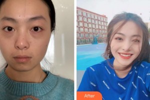 杭州格萊美整形美容醫(yī)院徐云喜整形價格表附白瓷娃娃案例展示