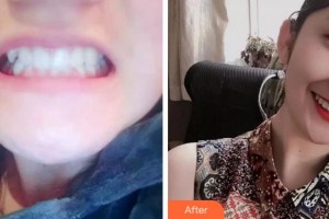 杭州時光醫(yī)療美容醫(yī)院葉學(xué)功整形價格表附牙齒陶瓷矯正案例展示