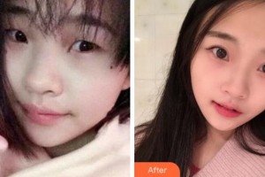 杭州瑞麗整形醫(yī)院徐少駿整形價格表附切開雙眼皮案例展示