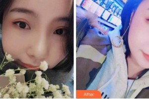 杭州瑞麗整形醫(yī)院林莉整形價格表附牙齒隱形矯正案例展示