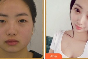 杭州藝之花醫(yī)療美容醫(yī)院楊海波整形價格表附眼部綜合案例展示