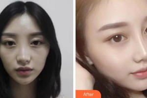 杭州格萊美整形美容醫(yī)院崔順宇整形價(jià)格表附鼻部綜合案例展示