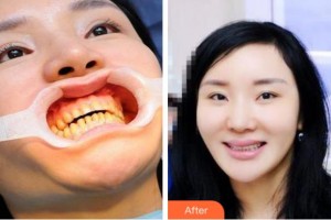 杭州格萊美整形美容醫(yī)院李東燦整形價(jià)格表附美白貼片案例展示