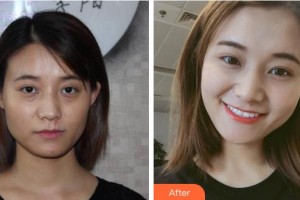 杭州愛琴海醫(yī)療美容醫(yī)院程磊整形價(jià)格表附埋線提升案例展示