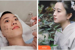 杭州愛琴海醫(yī)療美容醫(yī)院朱金土整形價(jià)格表附熱瑪吉案例展示