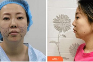 杭州愛琴海醫(yī)療美容醫(yī)院傅其宏整形價(jià)格表附埋線提升案例展示