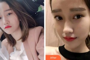 杭州愛琴海醫(yī)療美容醫(yī)院胡旭東整形價(jià)格表附牙齒隱形矯正案例展示