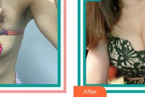 杭州邵逸夫醫(yī)院整形美容中心邵雁整形價(jià)格表附自體脂肪隆胸案例展示