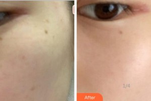 杭州時(shí)光醫(yī)療美容醫(yī)院張壽麗整形價(jià)格表附激光祛斑案例展示