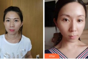 杭州珈禾整形美容醫(yī)院鄧華整形價(jià)格表附熱拉提案例展示