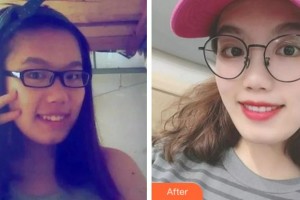 杭州華山連天美醫(yī)療美容整形醫(yī)院陳海濱整形價(jià)格表附隱形托槽矯正案例展示