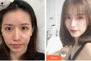 杭州華山連天美醫(yī)療美容整形醫(yī)院柳盈整形價(jià)格表附埋線提升案例展示