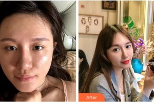 杭州華山連天美醫(yī)療美容整形醫(yī)院李斌斌整形價(jià)格表附埋線提升案例展示