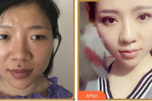 杭州整形醫(yī)院林潔整形價格表附眼部綜合案例展示