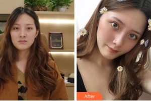 杭州整形醫(yī)院徐彬整形價格表附切開雙眼皮案例展示