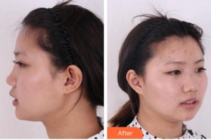 杭州整形醫(yī)院施嫣彥整形價格表附鼻部綜合案例展示