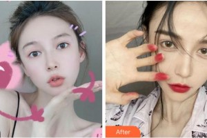 杭州整形醫(yī)院沈劍整形價格表附耳軟骨復(fù)合隆鼻案例展示