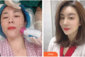 杭州王圣林美容整形診所王圣林整形價格表附熱瑪吉案例展示