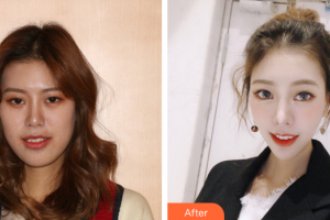 廣州市荔灣區(qū)口腔醫(yī)院吳海峰整形價格表附隱形托槽矯正案例展示