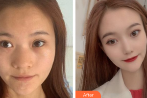 廣州美博匯醫(yī)療美容門診部黃祖成整形價格表附鼻部手術(shù)案例展示