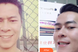 廣州市荔灣區(qū)口腔醫(yī)院張娟整形價格表附牙齒矯正案例展示