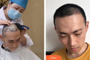 廣州美博匯醫(yī)療美容門診部羅科義整形價格表附植發(fā)案例展示