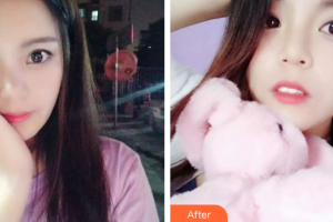 廣州市荔灣區(qū)口腔醫(yī)院莫閭妍整形價格表附牙齒隱形矯正案例展示