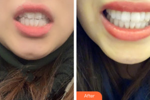 廣州嘉美口腔門診部朱衛(wèi)紅整形價格表附隱形托槽矯正案例展示