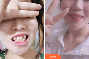 廣州市荔灣區(qū)口腔醫(yī)院魏鴻明整形價格表附牙齒矯正案例展示