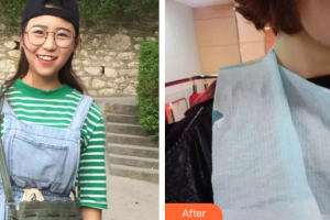 廣州市荔灣區(qū)口腔醫(yī)院蔣潔整形價格表附牙齒矯正案例展示