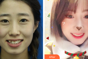 廣州嘉美口腔門診部宛敏整形價(jià)格表附金屬托槽矯正案例展示