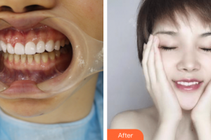 廣州嘉美口腔門診部陳星整形價(jià)格表附牙齒貼面案例展示