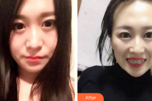 廣州梅里奧口腔門診部馮銳整形價(jià)格表附金屬托槽矯正案例展示