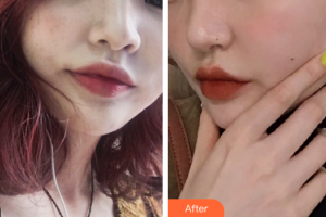 廣州美博匯醫(yī)療美容門診部胡春艷整形價(jià)格表附激光美膚激光案例展示