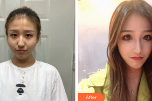 廣州曙光醫(yī)學(xué)美容醫(yī)院范丹整形價格表附顴骨顴弓案例展示